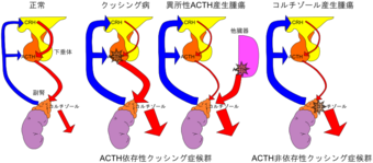 799px-Cushing_syndrome_illustration.svg.png